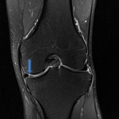 2015-01-MRI-left-knee-from-front-with-arrow