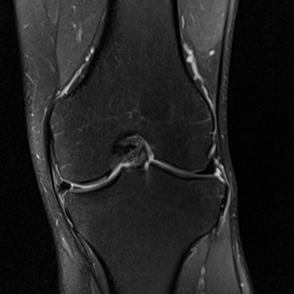 knee-mri-trialog-a-triathlon-blog