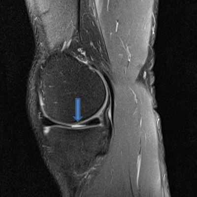 2015-01-MRI-left-knee-from-left-with-arrow